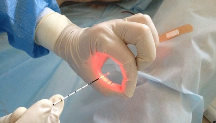 Trattamento laser per la prostatite